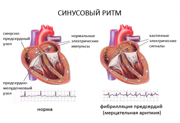 Аритмия - Причины, симптомы и лечение аритмии сердца | IMPULS 24/7