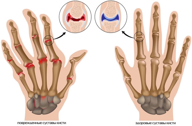 ATOS – Ваши специалисты по лечению заболеваний кистей рук в Германии