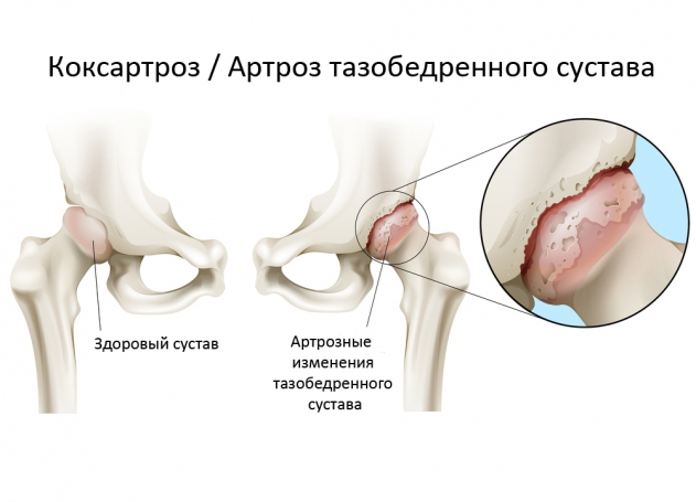 Коксартроз (остеоартроз тазобедренного сустава) и его лечение